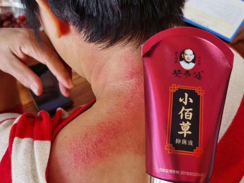 黄飞鸿小佰草抑菌液调理案例
