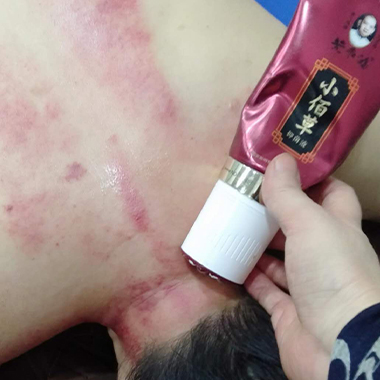 黄飞鸿小佰草抑菌液肩周炎刮痧案例(图1)
