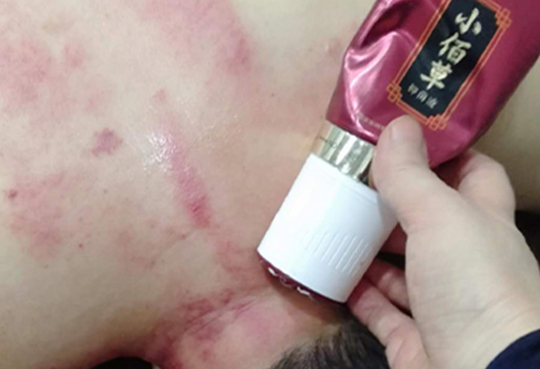黄飞鸿小佰草抑菌液刮痧案例